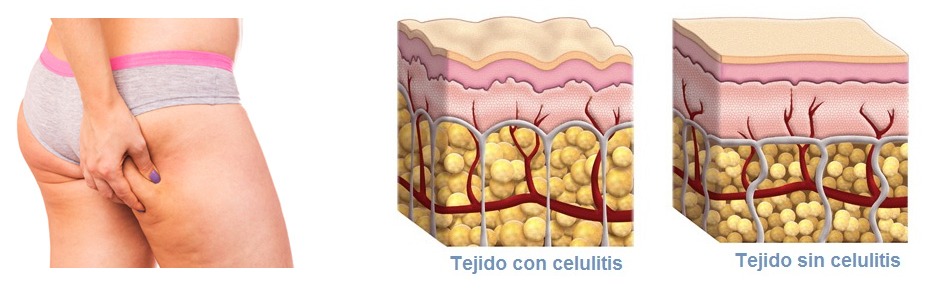 Tejido con celulitis