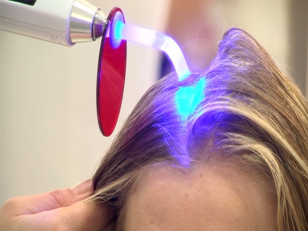 fototerapia en el cabello