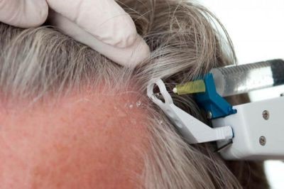 laser para caida del cabello