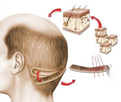 transplante de cabello